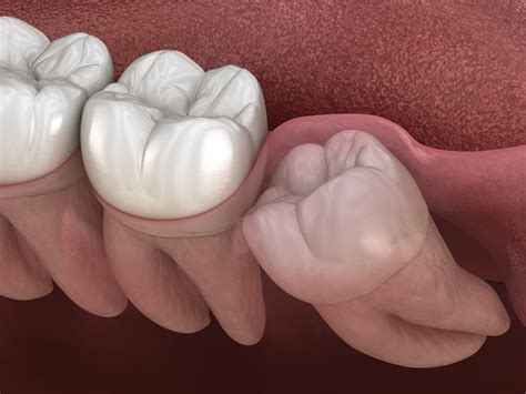 How to Care for an Erupted Wisdom Tooth - Dental Concepts and Orthodontics