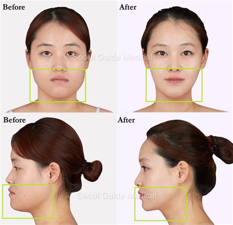 What Types Of Jaw Surgery Are There at Jaxon Lawson blog