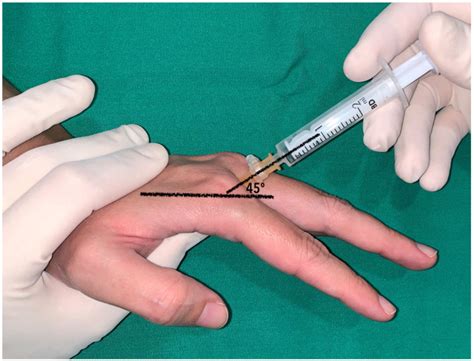 [Translated article] Out-of-sheath corticosteroid injections through the dorsal webspace for ...