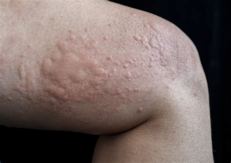 Urticaria Treatment