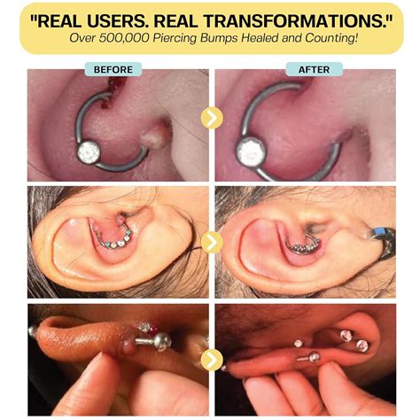 BASE LABORATORIES Keloid Bump Removal Gel | Natural Sri Lanka | Ubuy