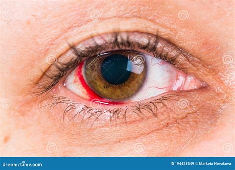 Detail of Woman Brown Eye with the Damage and Blood in Eye Stock Image - Image of blood, brown ...