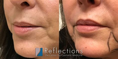 Lip Fillers New Jersey - Livingston & Bridgewater, NJ