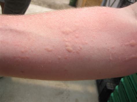 Types Of Insect Bite Rashes at James Marts blog