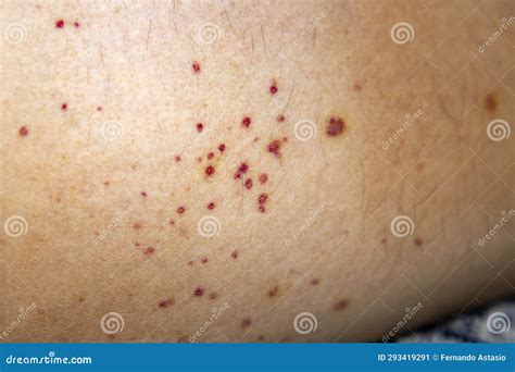 Vasculitis. Vasculitis in Legs. Small Red or Purple Spots. Rare Disease. Stock Image - Image of ...