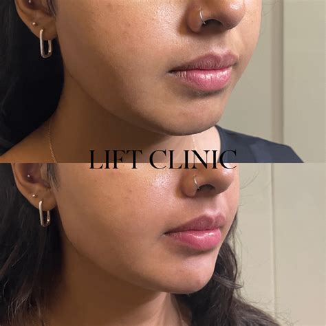 Dermal Fillers Before and After - Lift Clinic Toronto