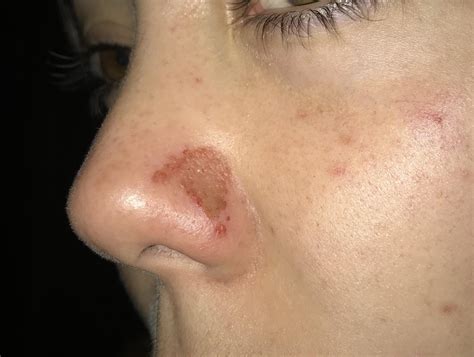 Scab In Nose Won't Heal