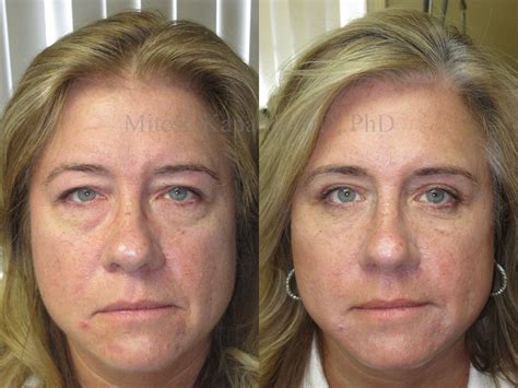Before and six weeks after upper and lower blepharoplasty surgery | Boston Eyelid Surgery