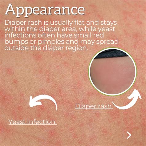 Baby Yeast Infection Vs Diaper Rash