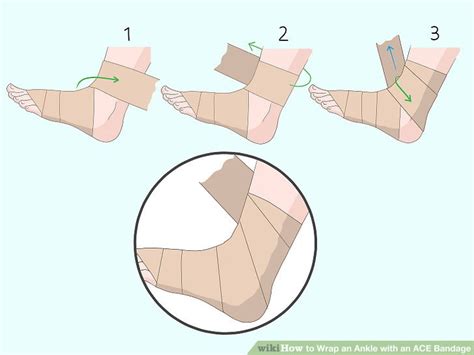 How To Wrap Ace Bandage For Sprained Ankle at Darren Pennington blog
