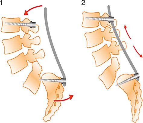 Spondylolisthesis Grade