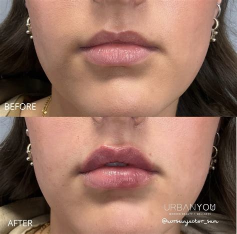 Lip Flips: What to Expect, Before & After Photos, and More — Urban You - Modern Beauty + Wellness