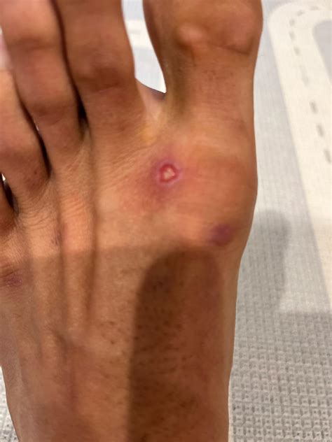 Friction burn. Is this infected or a scab forming? : r/woundcare