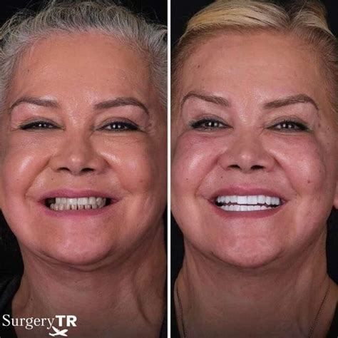 Dental Implants in Turkey (Tooth Implant) | SurgeryTR