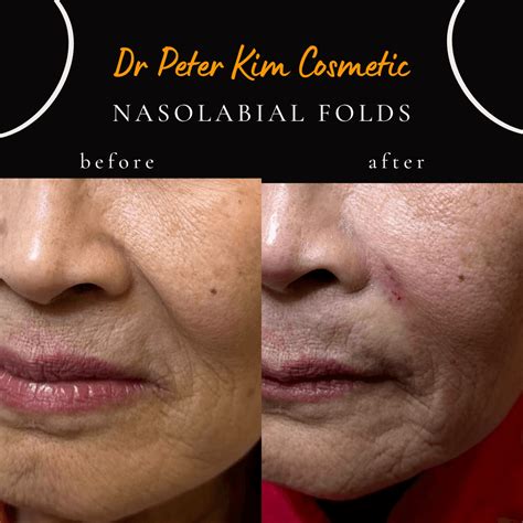 Dermal Fillers For Nasolabial Folds Best Smile Line Filler In NYC