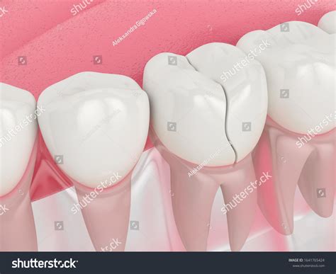 83 Types Of Cracked Teeth Images, Stock Photos & Vectors | Shutterstock