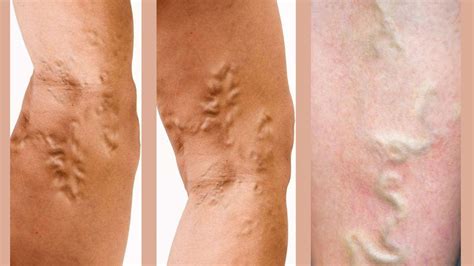 Why Are My Veins So Prominent? Understanding the Causes - Elite Vascular | New Jersey's Trusted ...