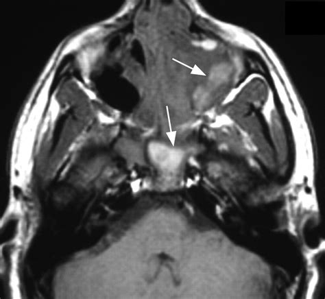 Imaging Features of Invasive and Noninvasive Fungal Sinusitis: A Review | RadioGraphics