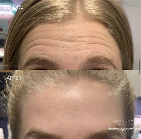 Botox for Jaw Pain and TMJ Relief — Urban You - Modern Beauty + Wellness