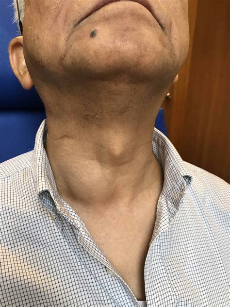 Lump On Child's Neck