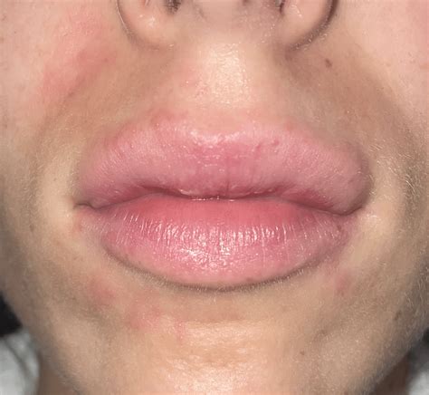Face Rash Under Lip at Iva Blackburn blog