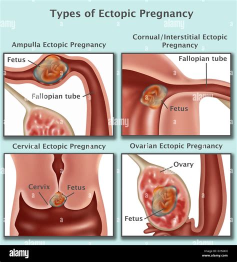 Cornual ectopic pregnancy hi-res stock photography and images - Alamy