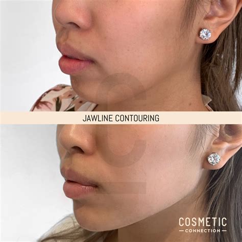 Jawline Contouring in 2025 | Face plastic surgery, Facial fillers, Jawline