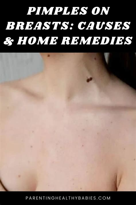 Best 13 Pimples on Breasts: Causes and Home Remedies – Artofit