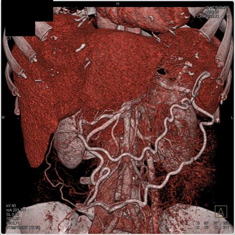 Adenocarcinoma Pancreas - Pancreas Radiology Case Studies - CTisus CT ...