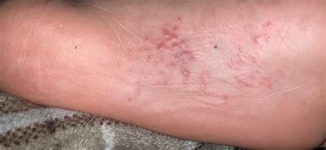 Little Red Dots On Top Of Foot That Itch Best Sale | emergencydentistry.com