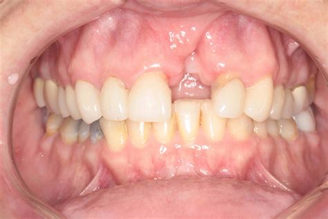 Can You Rebuild Bone Loss In Teeth at Alexander Ogilvie blog