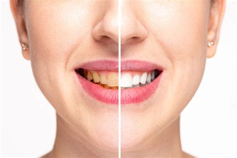 Best Ways to Remove Yellow Stains from Teeth Easily