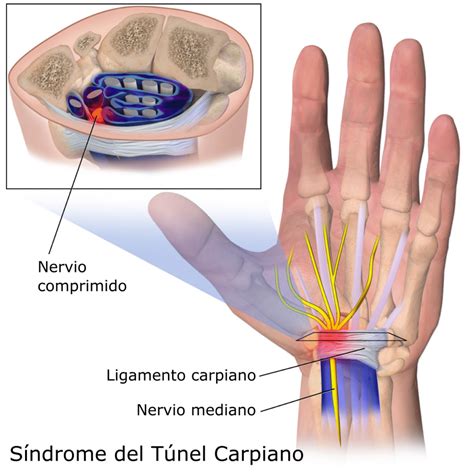 Síndrome del Túnel Carpiano ¿Qué es?- Clínica Fuensalud