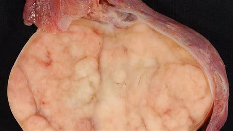 How To Cure Testicular Cancer (Testicular Germ Cell Tumor) | AllCancer