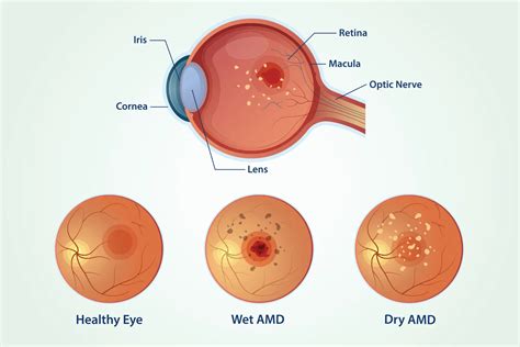 Exudative Amd
