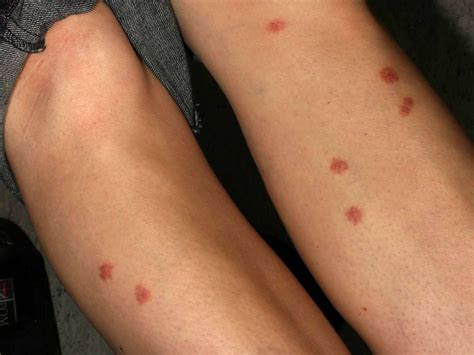 Types of Bug Bites: Symptoms and Treatments