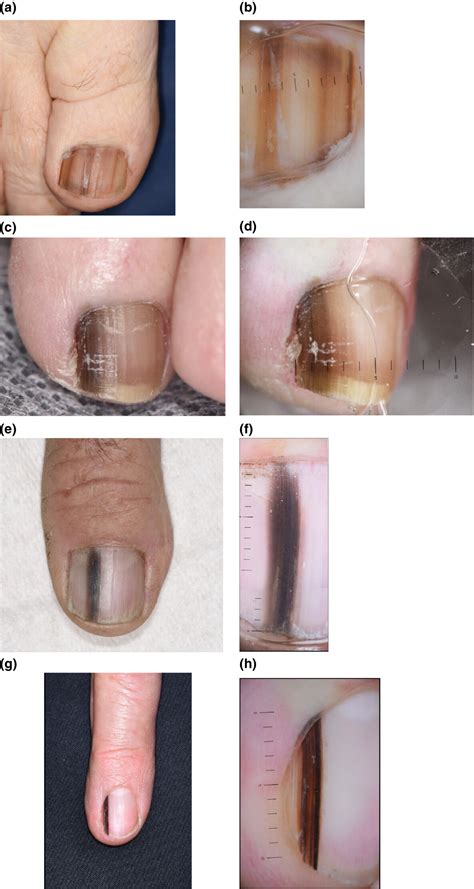 Nail Melanoma Treatment