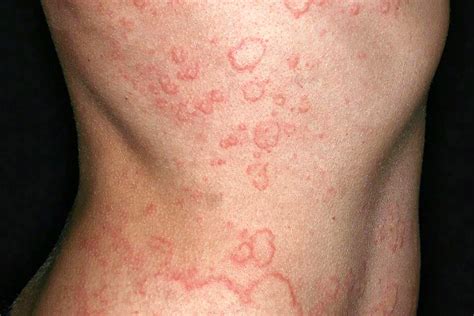 Chronic Spontaneous Urticaria: What to Know - Isarer.com