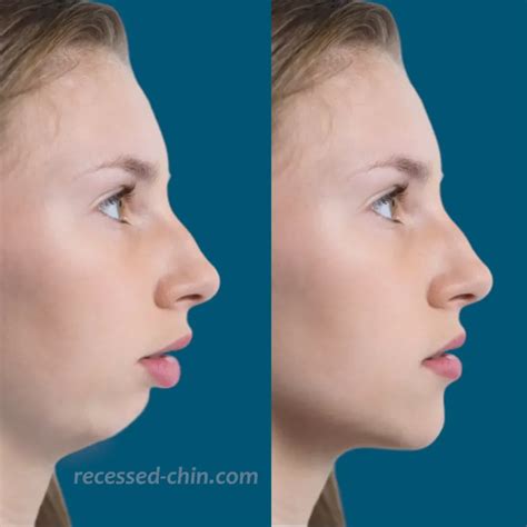 Receding chin photo - Surgical before-and-after simulator