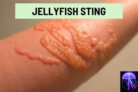 How To Treat Rash After Jellyfish Sting at Emily Jenkins blog