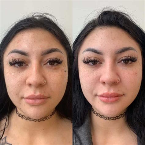 9 Amazing PRP Facial Benefits - the daily glimmer