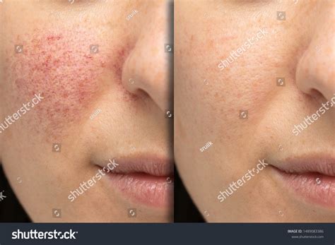 Before After Laser Treatment Rosacea Couperose Stock Photo (Edit Now) 1489083386
