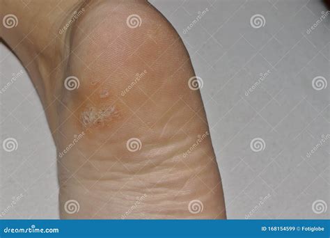 Plantar Wart Close Up On The Bottom Of A Female Foot Heel Caused By The Human Papillomavirus, Or ...