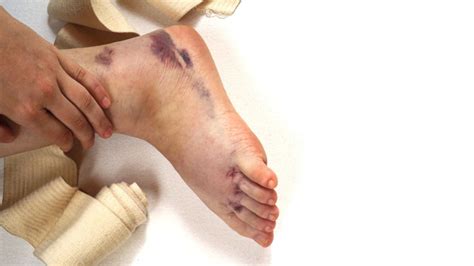 Does Ice Help with Inflammation? - Propel Physiotherapy