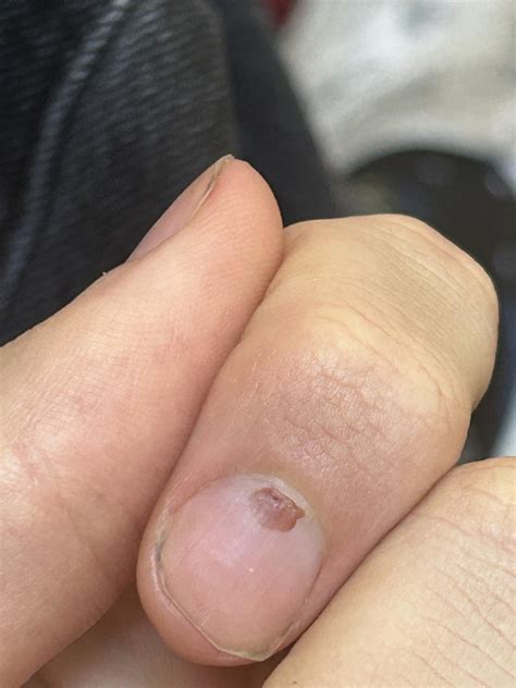 Does this look like melanoma? 20 male and noticed this under my index nail : r/Melanoma