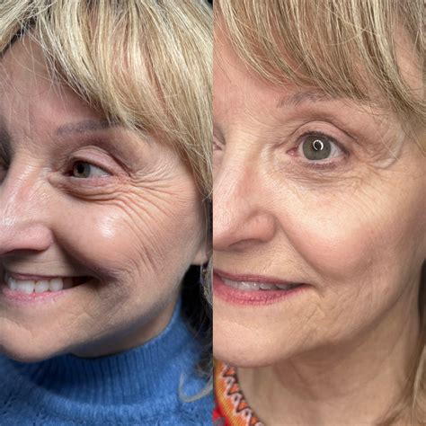 Polynucleotide Treatment | Salmon Sperm Facial | Faces By Bae