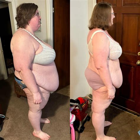 1 year post op! Down 170 pounds : r/BariatricSurgery