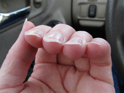 How To Fix Crooked Fingernails at Erin Patteson blog