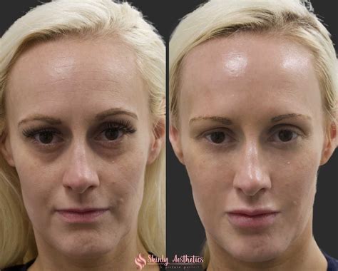 Under Eye Fillers - Before & After Results at Skinly