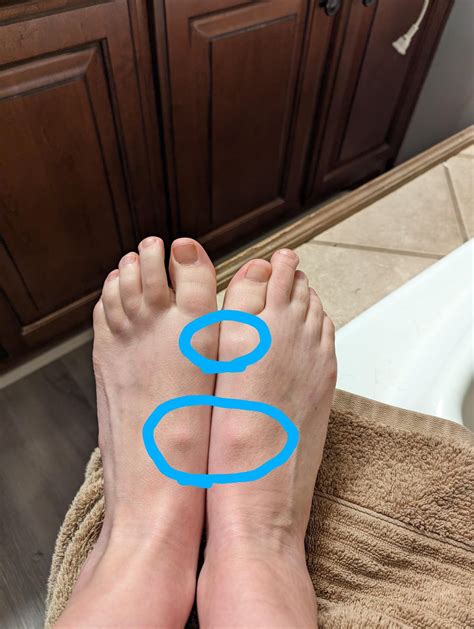Bump on top of foot : r/medical_advice